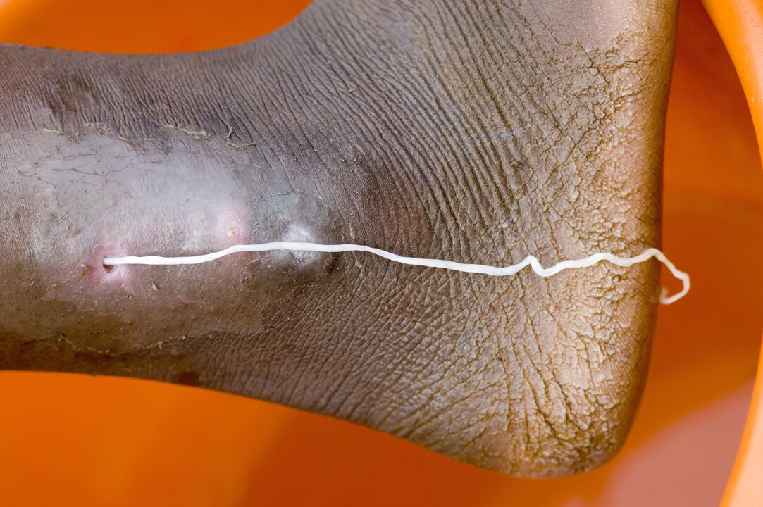 Guinea worm